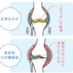 変形性膝関節症（O脚）について